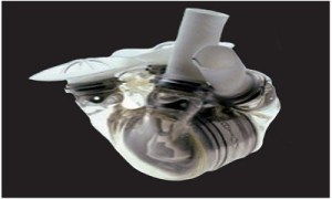 artificial-heart-1985